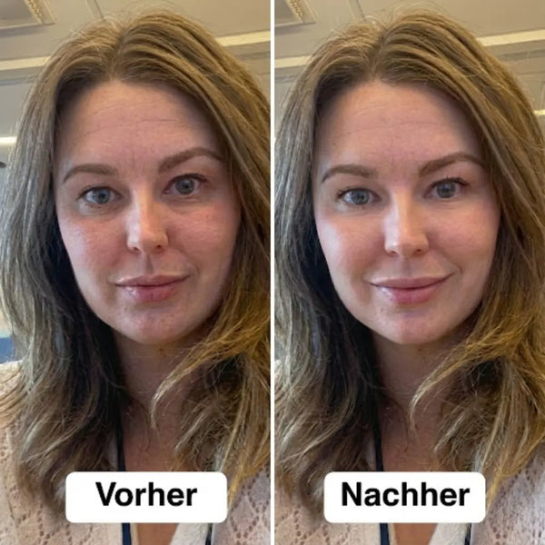 Vorher/Nachher Synea